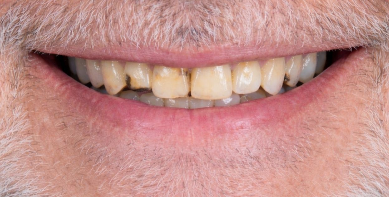 Paciente antes del tratamiento de implantes