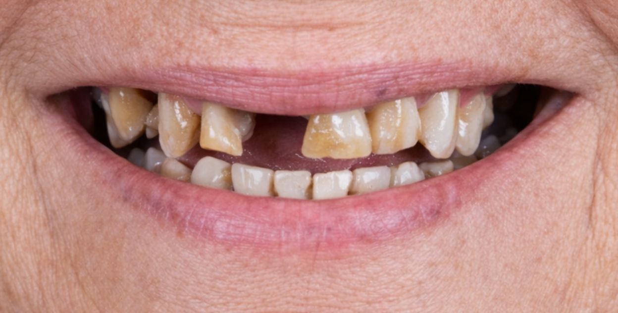 Resultado de implantes antes