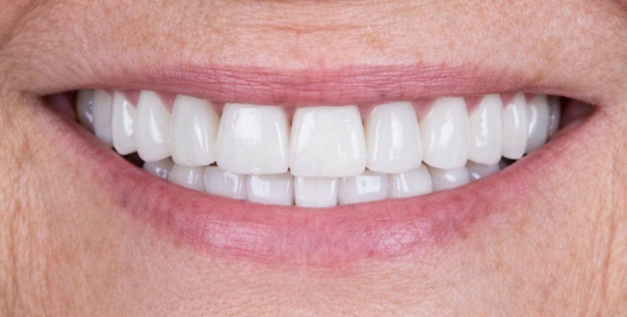 Resultado de implantes después