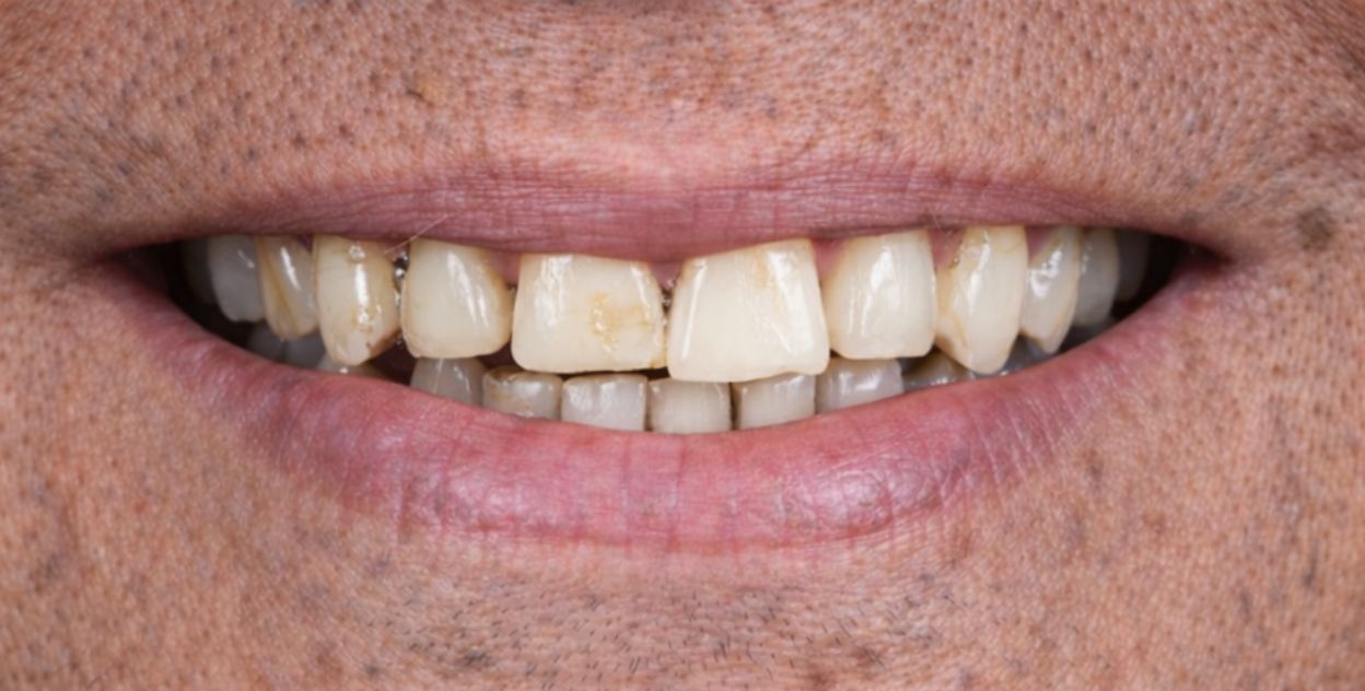 Implantes dentales antes