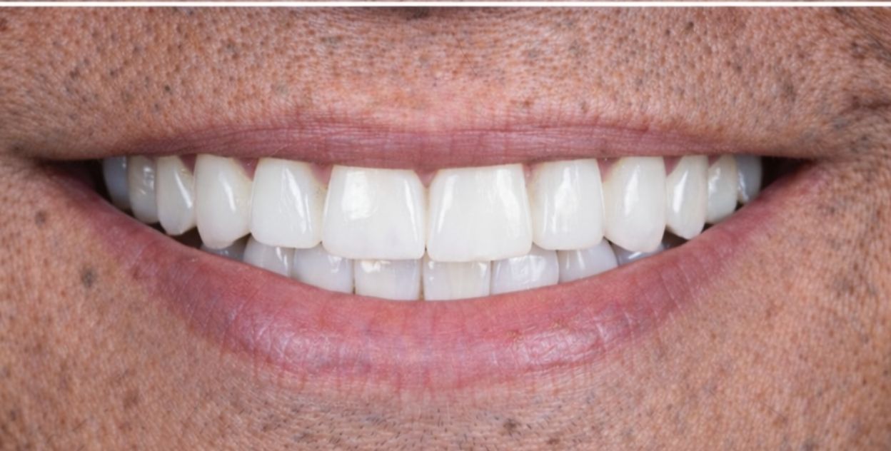 Implantes dentales después