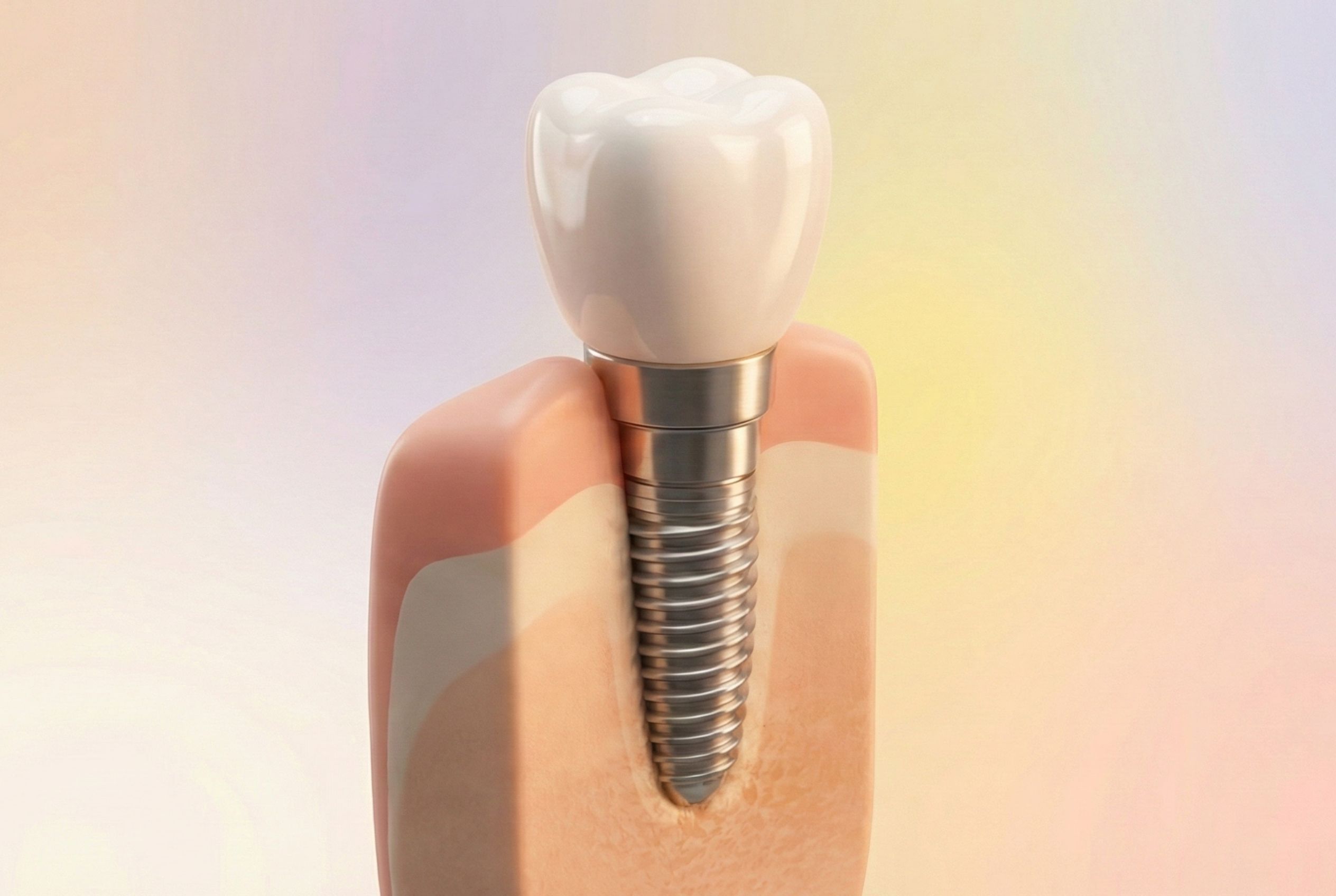 Tipos de implantes dentales y precios